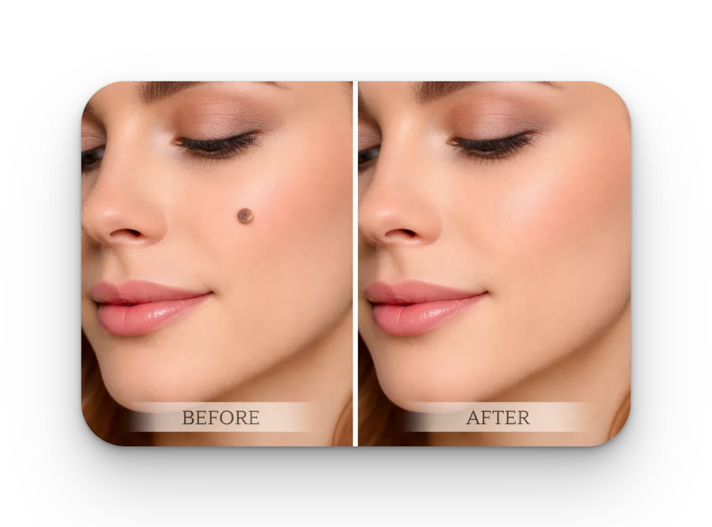 Mole & Skin Tag Removal