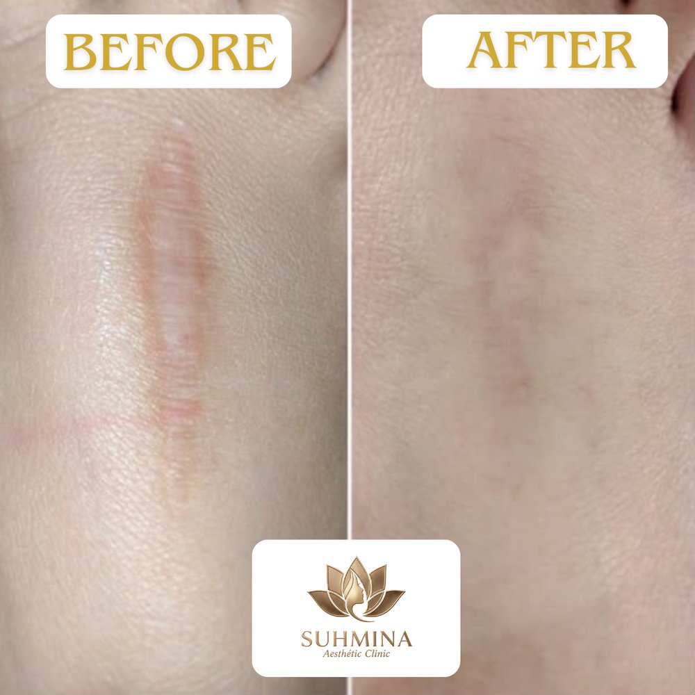 Before and After Results