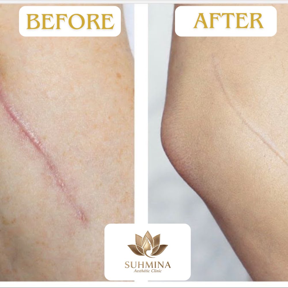 Before and After Results