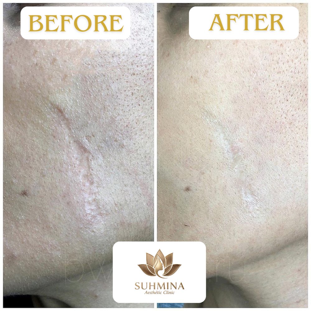 Before and After Results