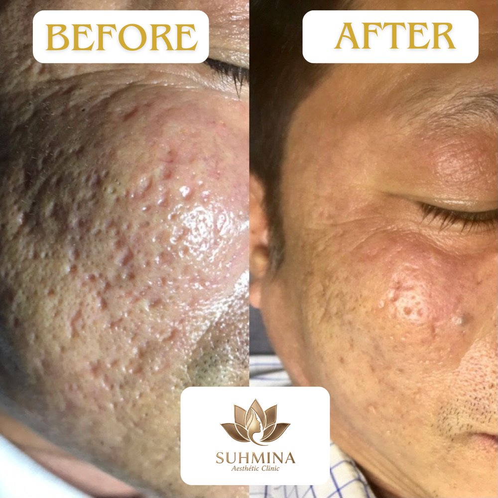 Before and After Results