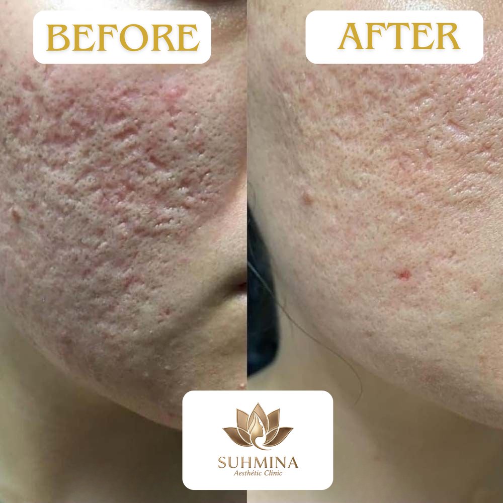 Before and After Results